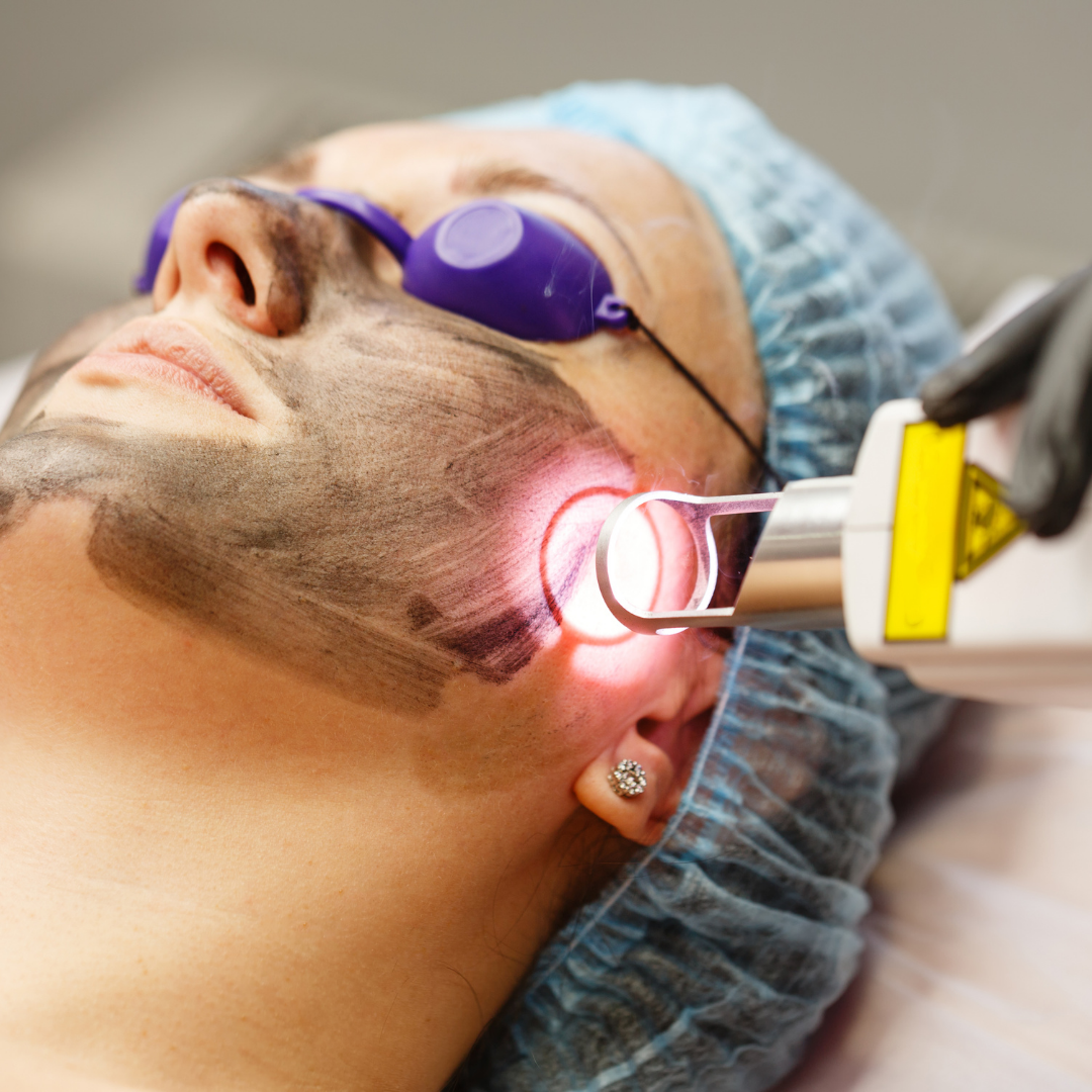 Carbon Laser Facial Process
